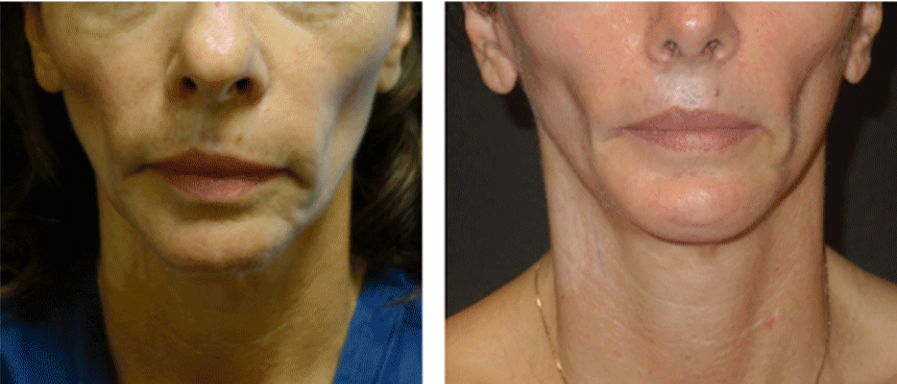 Chin Surgery in Plano, TX - www.drplano.com