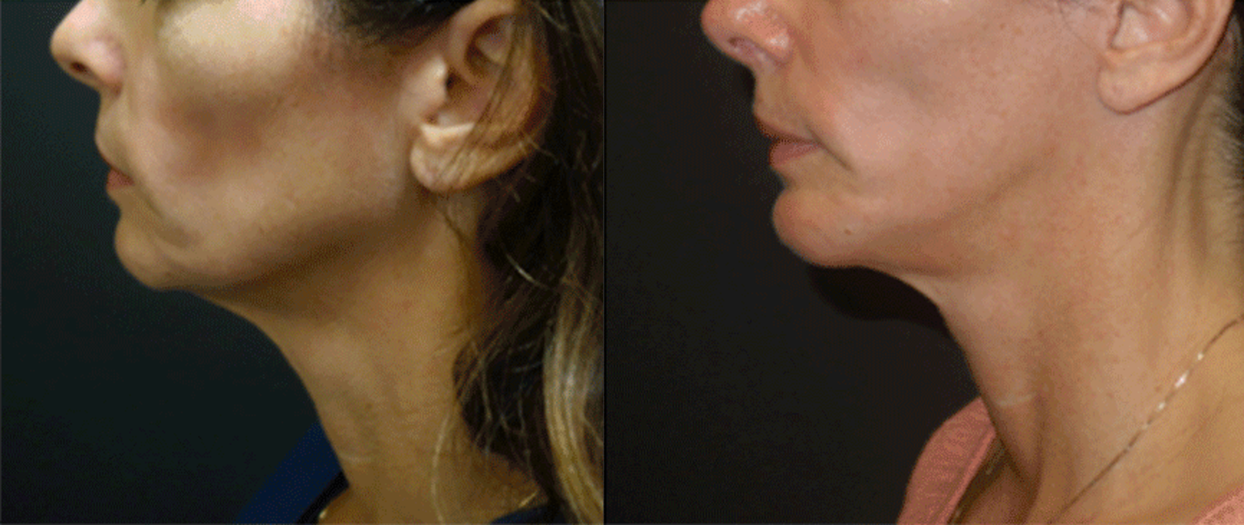 Chin Surgery in Plano, TX - www.drplano.com