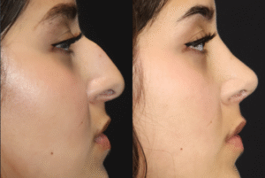 Rhinoplasty Before and After
