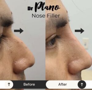 Nose filler before and after